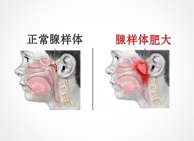 腺样体