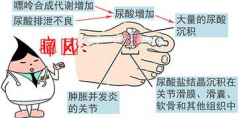 <b>痛风的典型症状</b>