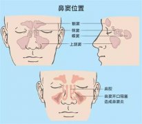<b>流鼻涕了！是鼻窦炎还是过敏？</b>
