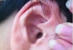 <b>耳朵里面长“痘痘”是怎么回事</b>