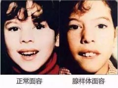 <b>教你如何区分小孩腺样体肥大</b>